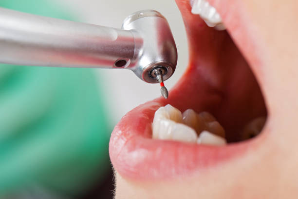 Best Lost Filling or Crown Replacement in Bethesda, OH